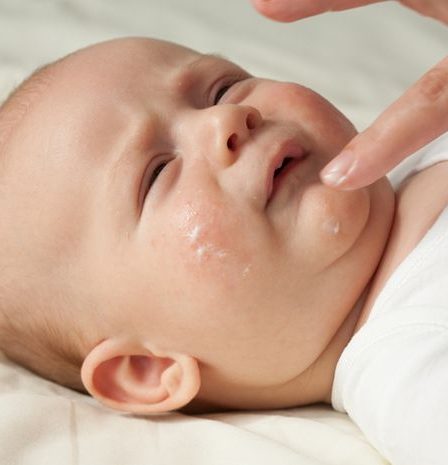 penyebab dan cara mengatasi iritasi kulit pada bayi